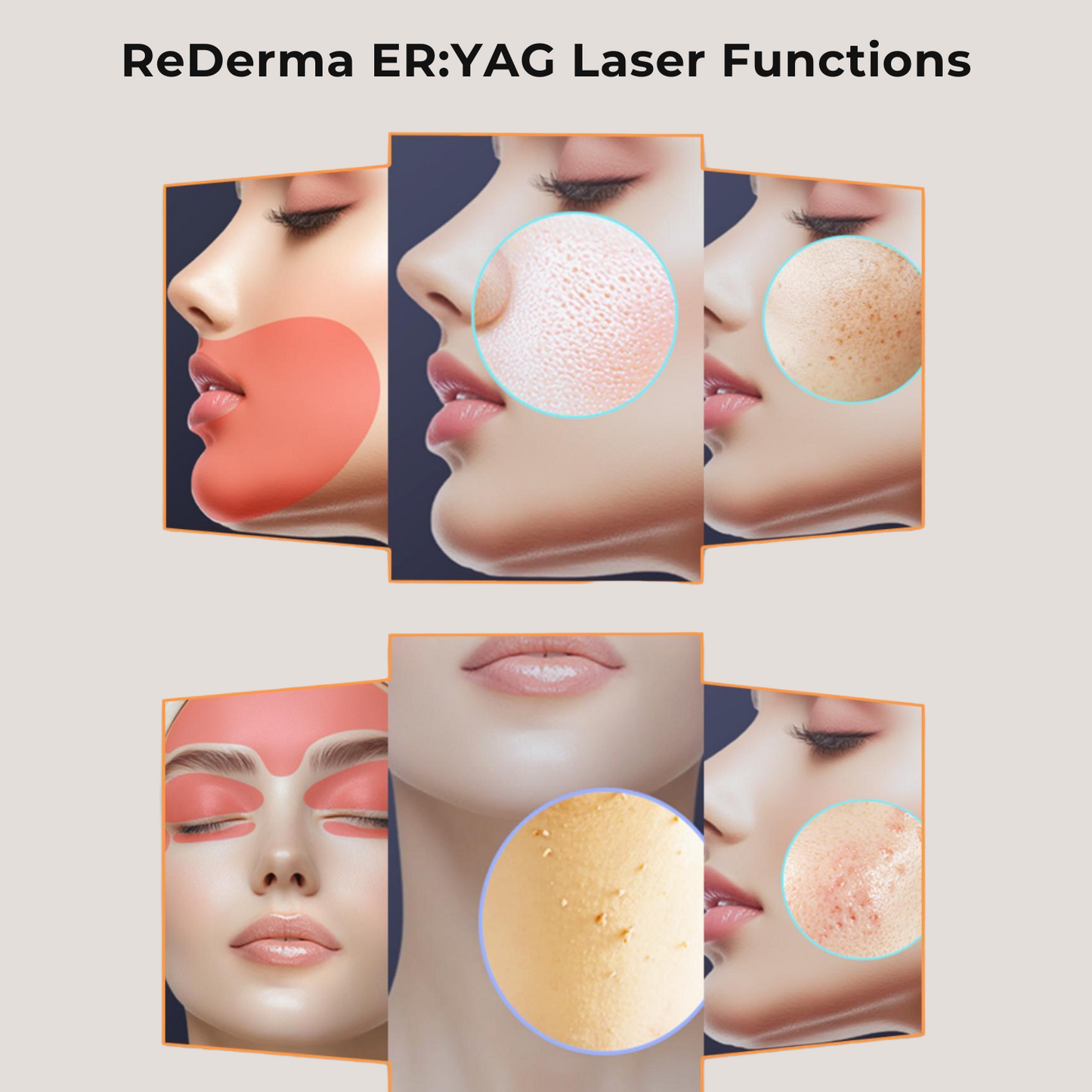 ReDerma ER:YAG Superior Absorption Erbium Laser