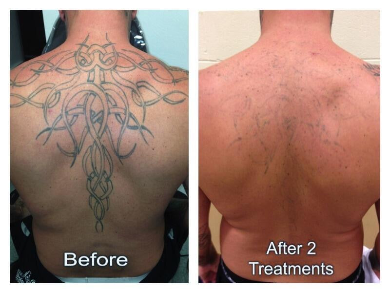 Tattoo removal performance