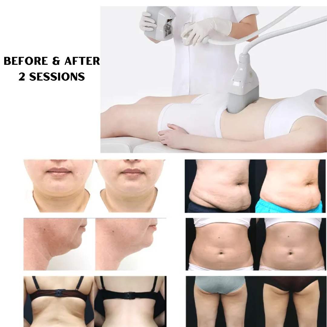 comparison after using fat freezing machine