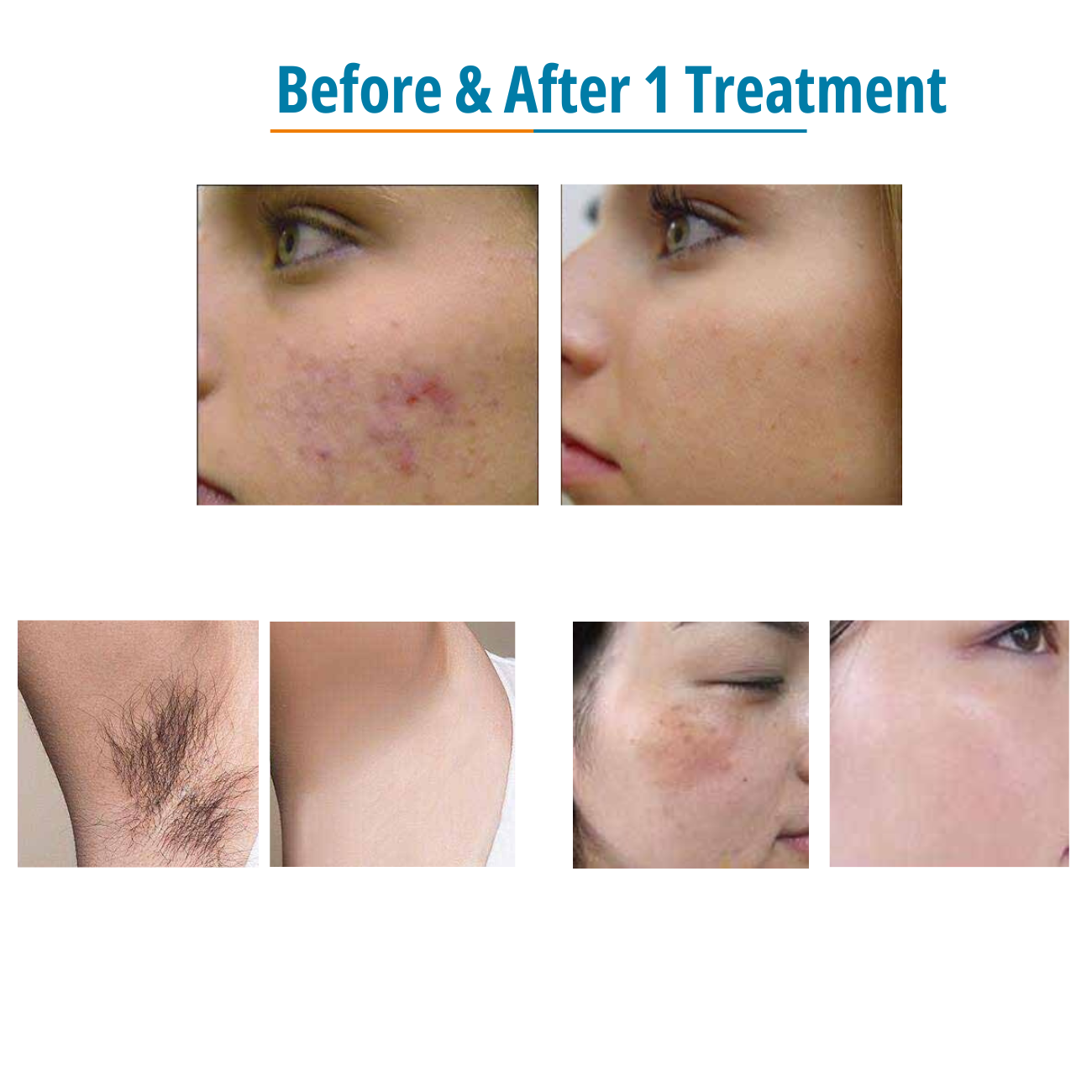 DermaLaze Delicate Pulsed Light System