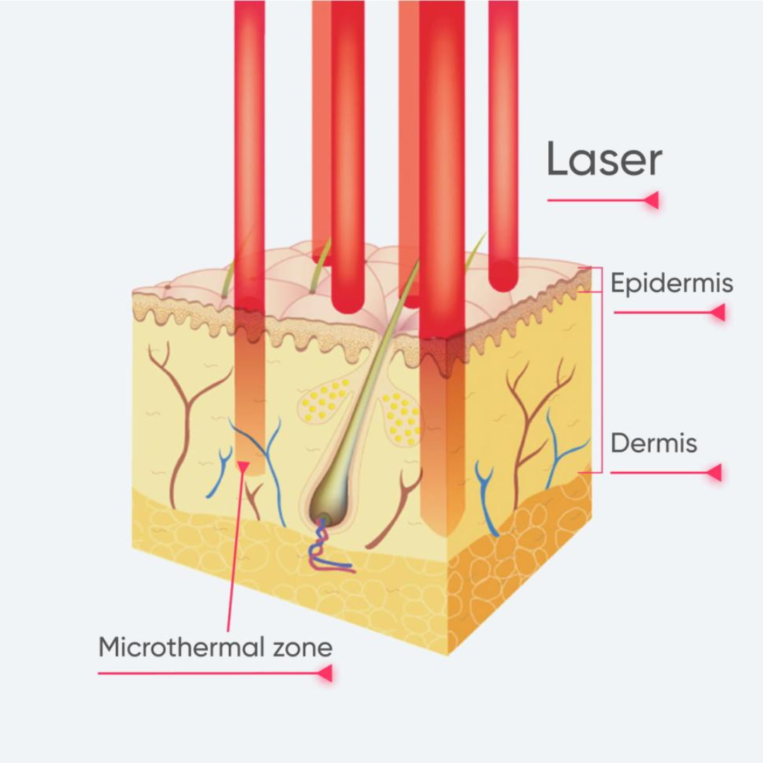 CarbonFrax Pro CO2 Fractional Laser