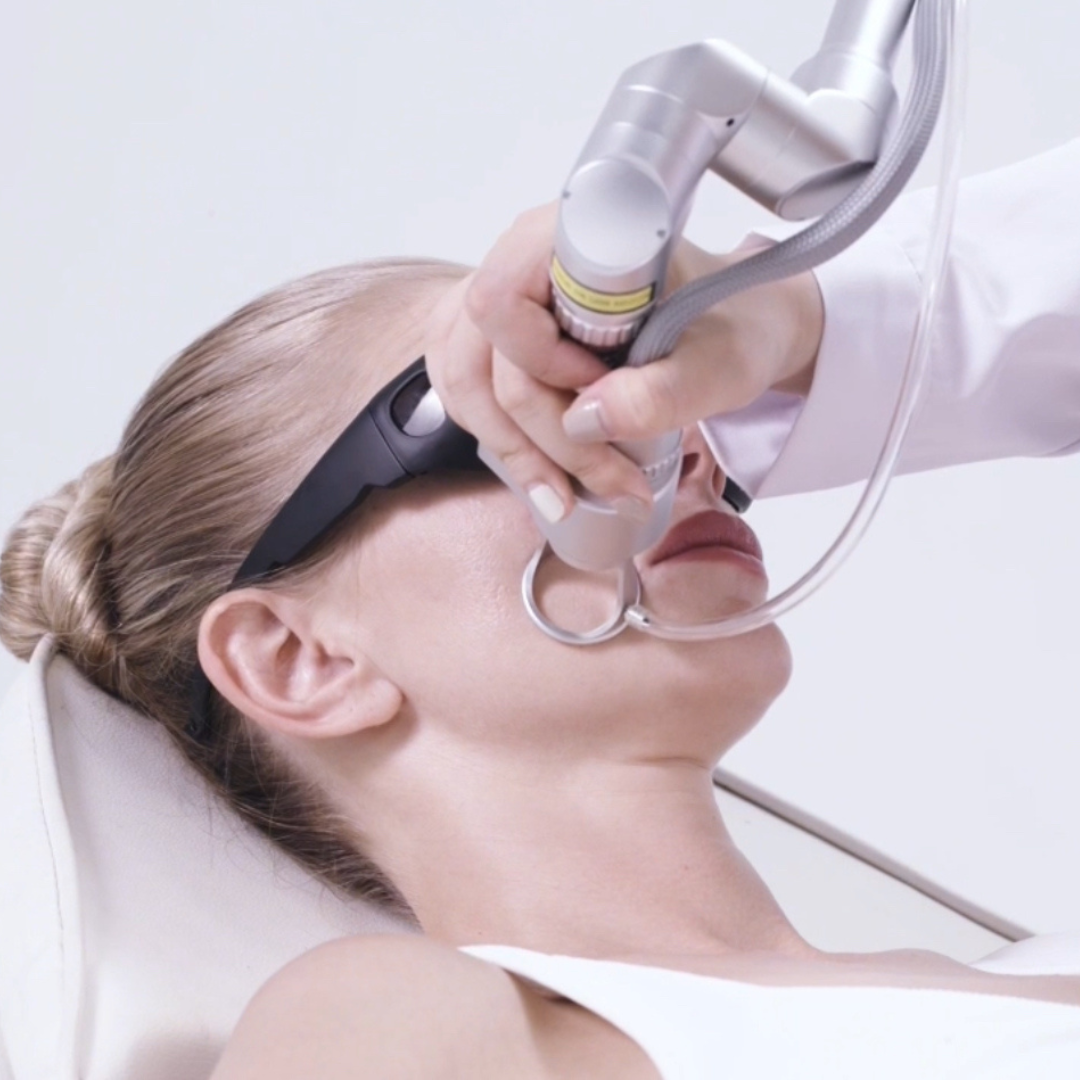 CarbonFrax Pro CO2 Fractional Laser