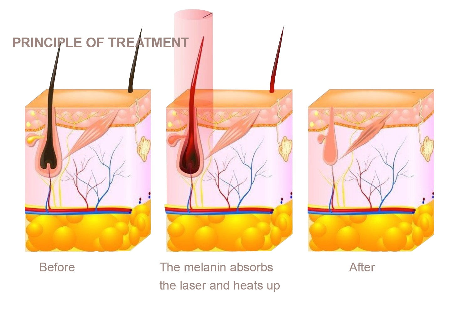 Principle of Diode Laser Skin Treatment for Hair Removal 