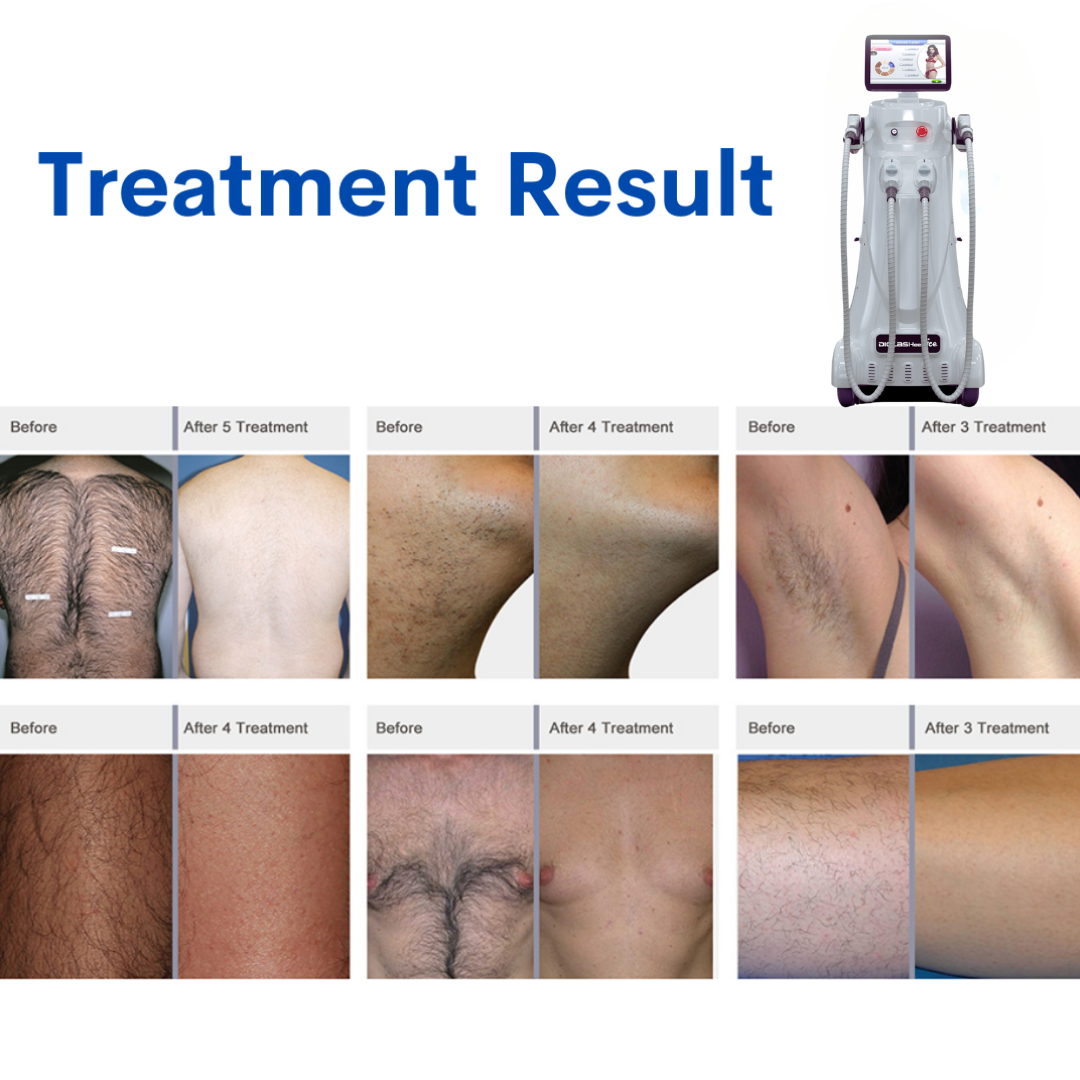 DiolaSheer Ice Hair Removal Laser Machine (4 Wavelengths)